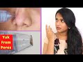 Remove Black & White Heads, I tried this on my sister||Dermasuction pore cleaning device Hit or Miss