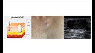 Ultrassonografia de cisto sebáceo na mama