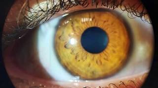 Multi CEO - OCT Segmento Anterior
