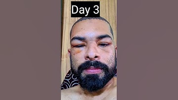 Thumbnail of Best Hair Transplant Results | 99524 19890 #hairtransformation #ameerht #hairtransplant
