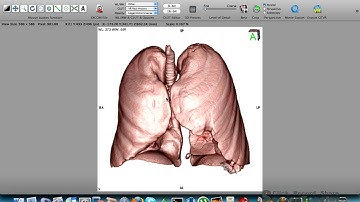 OSIRIX Demo - Tutorial VR Volume Rendering 3D Lung/Pulmão