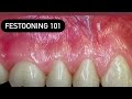 Festooning dentures(wax)