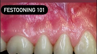 DENTURE FESTOONING #WAXBAE #DENTURES #WAX