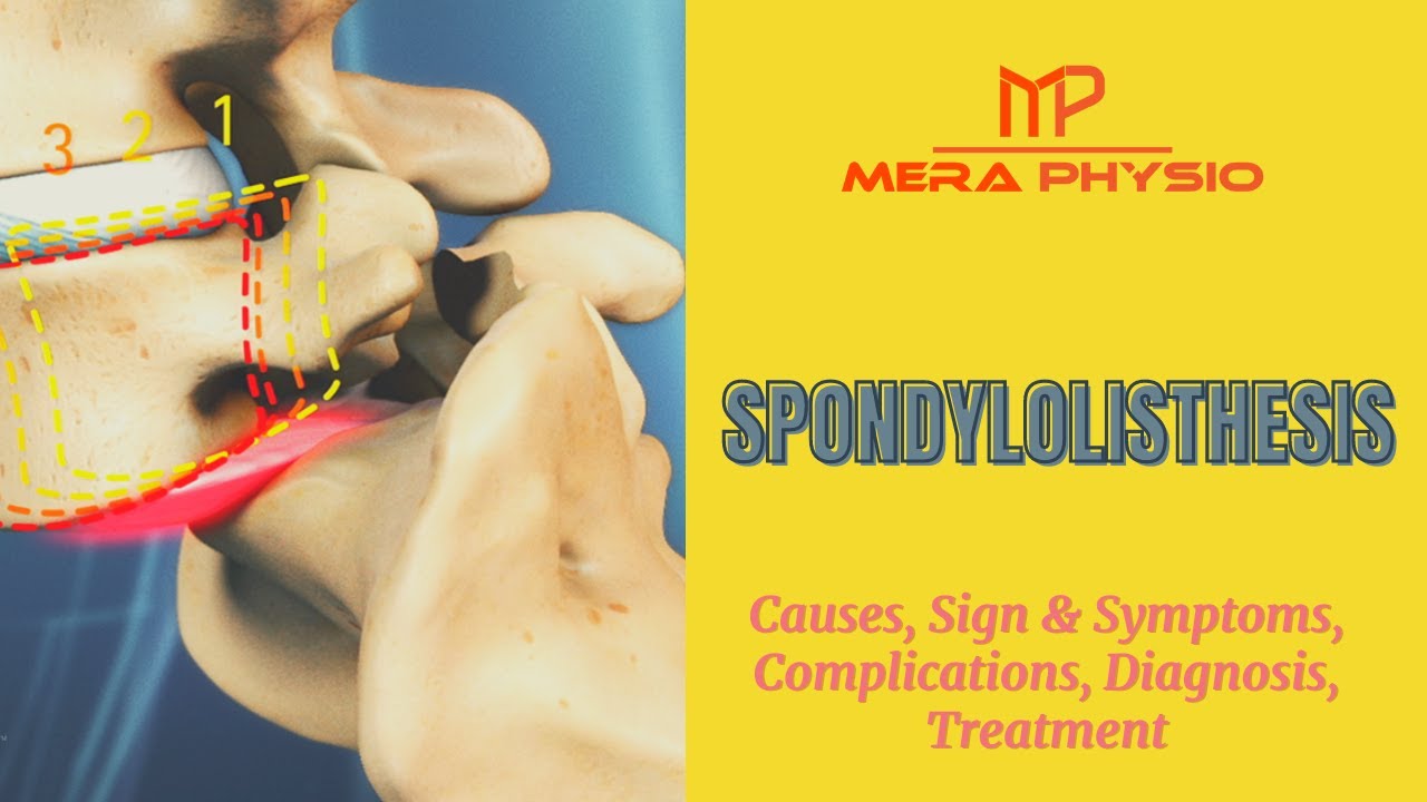 Spondylolisthesis Causes Sign Symptoms Complications Diagnosis spondylolisthesis-causes-sign-symptoms-complications-diagnosis