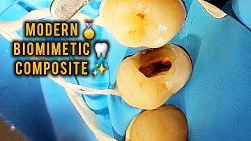 Advanced composite restoration using biomimetic principles 