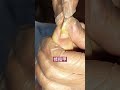 陥入爪を簡単にトリミングする方法 | Easy way to trim ingrown toenail Ep04