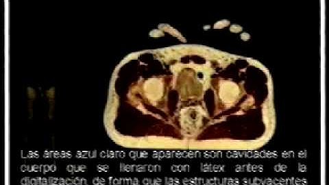 The Visible Human Project