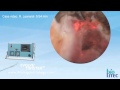 Laser treatment for bph enlarged prostate with evolver  michigan institute of urology