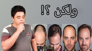 افضل طبيب لزراعة الشعر في مصر ولكن ؟