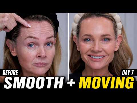 Russian Tox vs Traditional Placement | Why My Face Looks More Lifted