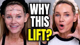 Russian Tox vs Traditional Placement | Why My Face Looks More Lifted