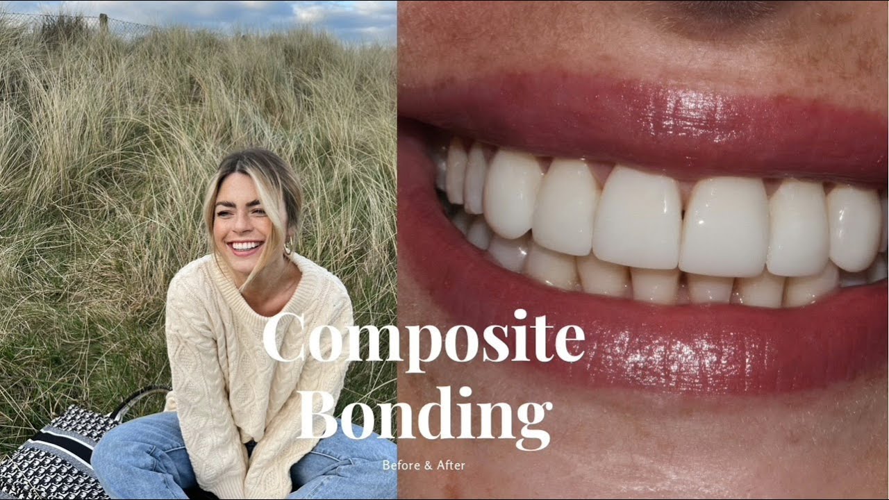 Dental Bonding Video  Tooth Bonding 