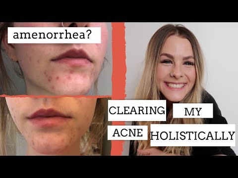 how-i'm-clearing-my-hormonal-acne-holistically|-got-my-period-back-after-9-months-of-amenorrhea