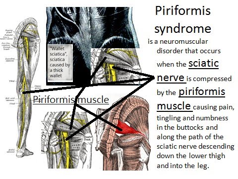 sciatica pain treatment sciatica pain treatment