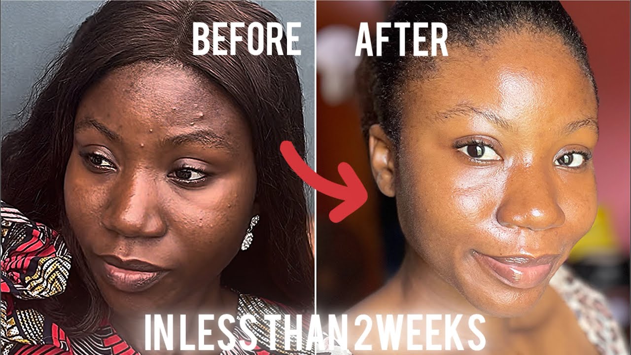 How i cleared my acne in less than 2 weeks | The third is the most ...