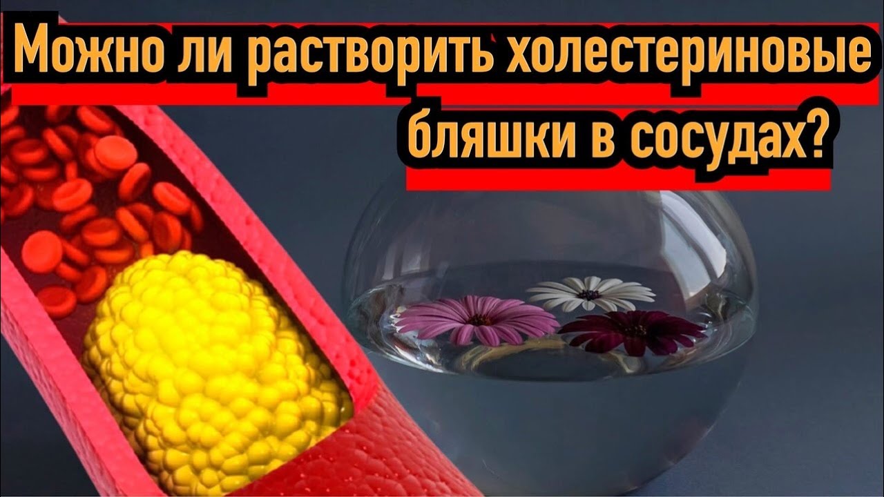 Жировые бляшки в сосудах. Как растворить холестериновые бляшки в сосудах. Как растворить холестериновые бляшки в сосудах. Как растворить холестериновые бляшки в сосудах. Атеросклеротические бляшки в сосудах.