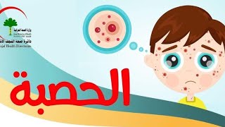 خطورة مرض الحصبة الأعراض وفترة الحضانة والعلاج وكيف يميز عن باقي الأمراض