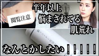 【半年以上治らない肌荒れ】完治の光りが見えてきた