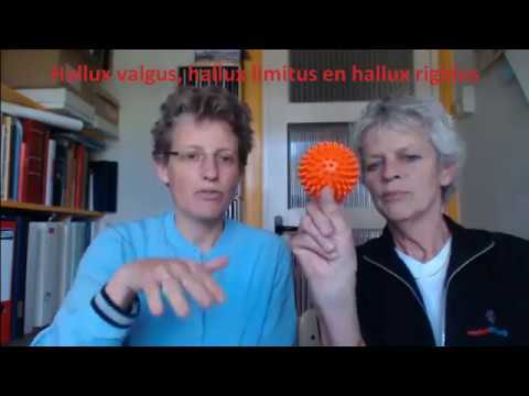 Video: Hallux Valgus Van De Kniegewrichten