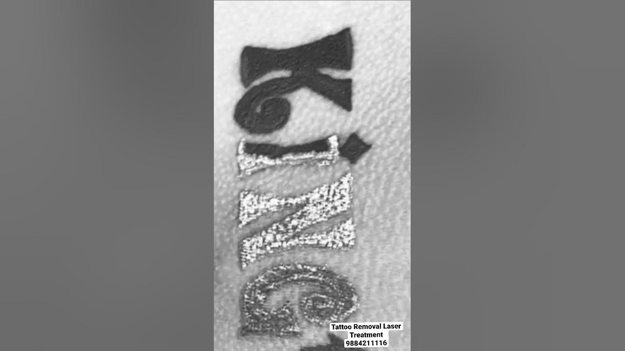Tattoo Removal In Ambattur Avadi Thirumullaivoyal 9884211116 tattoo-removal-in-ambattur-avadi-thirumullaivoyal-9884211116