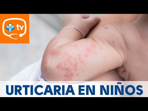 Video: Cómo Tratar Las Erupciones En Los Niños