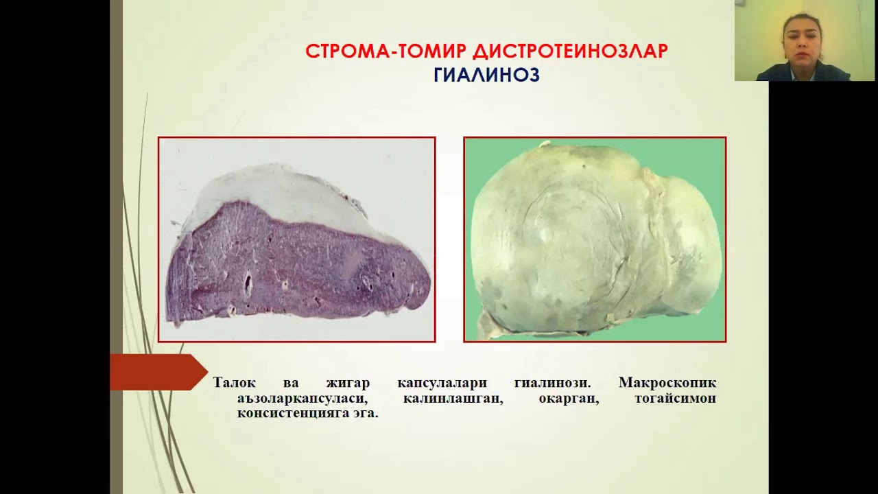 Мезехемал дистрофиялар