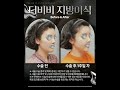#더비비성형외과 볼륨은 채우고, 자연스러움은 그대로!