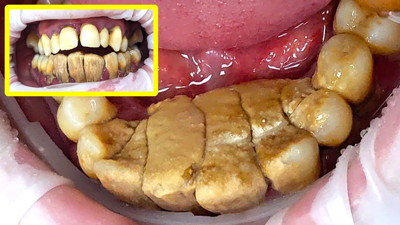 Plaque and tartar: how to prevent buildup on teeth 🦷