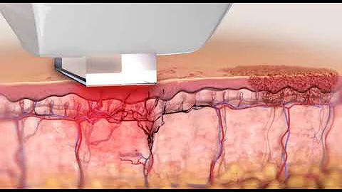 How Does Lumecca IPL Photo Rejuvenation Work?