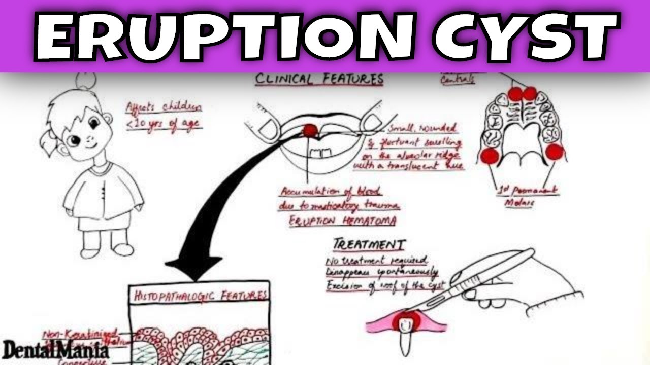 eruption cyst