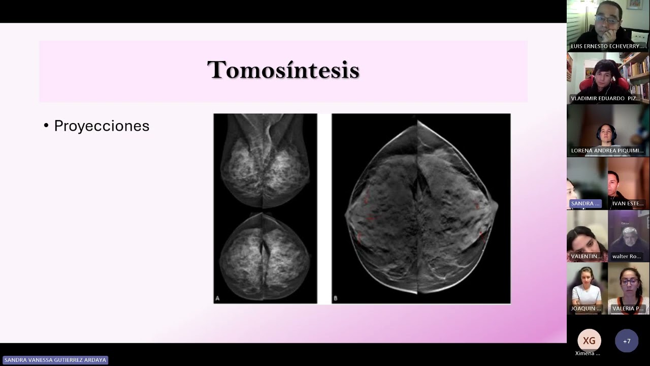 Métodos diagnósticos para cáncer de mama.