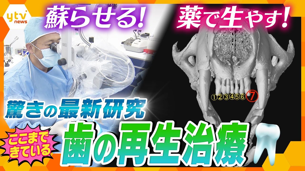 ひび割れた歯の治療