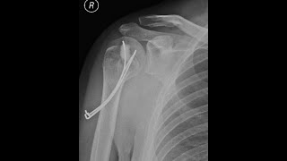 Palm Tree Fixation For 4 Part Head Split Locked Posterior Fracture Dislocation Of The Humeral Head