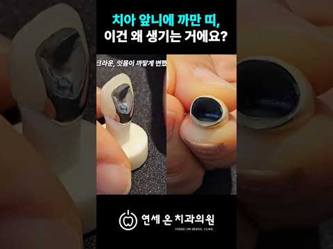 치아 앞니 까만띠 왜 생기는거에요 | 부산치과 연세온치과의원 — 연세온치과 유튜브 영상 썸네일