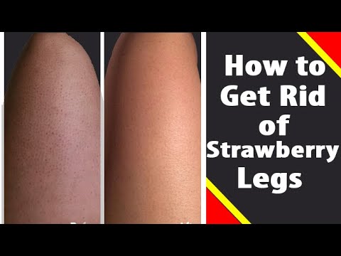 How to get rid of Strawberry legs at Home || Get Rid Of Strawberry Legs