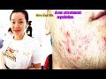 The best blackheads extractions,Acne Treatment at Hien Van Spa-390-Sú Minh Duy
