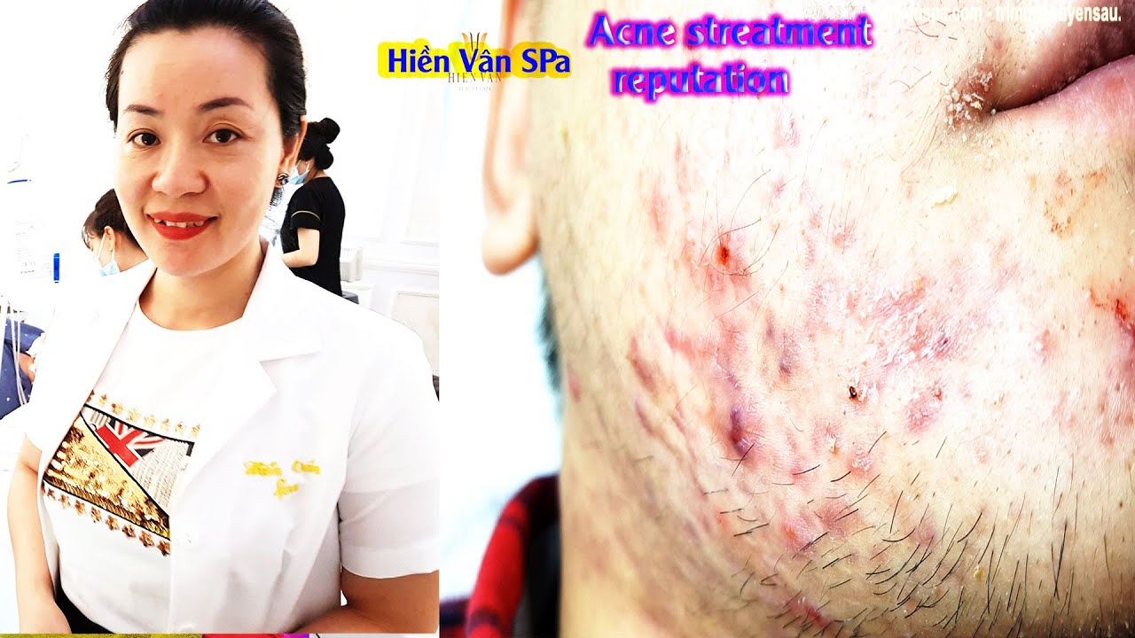 The best blackheads extractions,Acne Treatment at Hien Van Spa390Sú Minh Duy YouTube