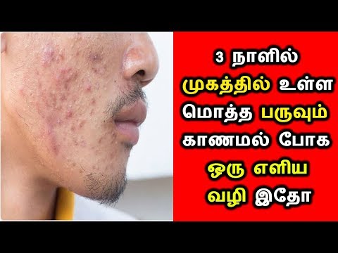 ஆண்கள் முகத்தில் உள்ள பருக்களை 3 நாளில் நீக்க எளிய வழி|Mens Pimple removing Easy Tips