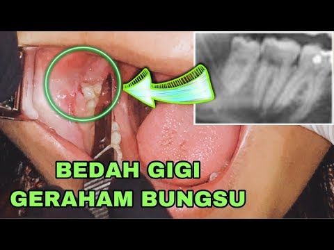 Belakang sakit gusi Gusi Bengkak