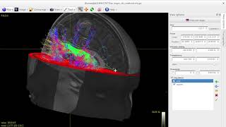 Tractography of arcuate fasciculus using MRtrix3