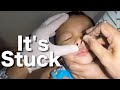 Plastic Bead Stuck Deep in Boy&#39;s Nose Removal