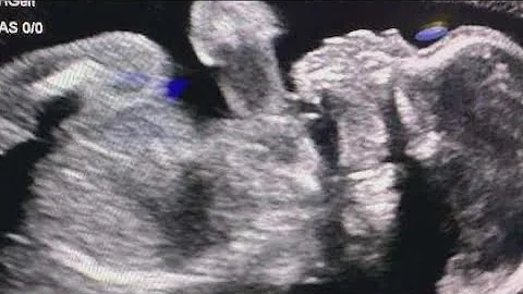 Baby born after brain-dead Georgia mom to be taken off life support today after four months