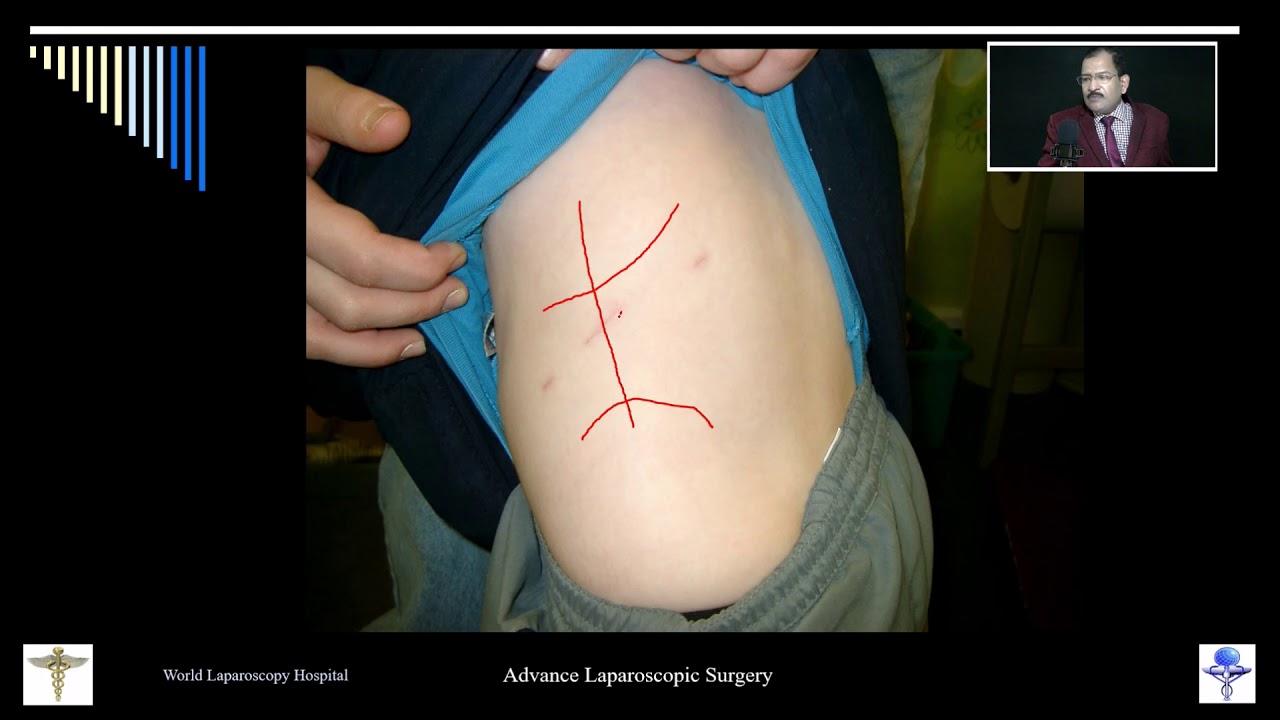 Retroperitoneoscopic Nephrectomy And Ureterolithotomy Youtube