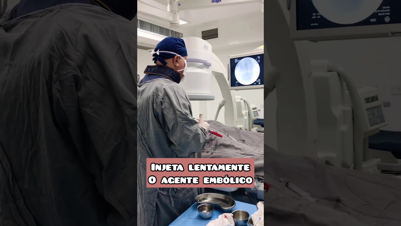 Embolização de Mioma