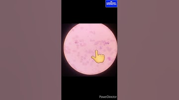 Sickle cell #sicklecellanemia # hematology # trand #shortvideo