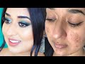 Affordable Full Coverage Foundation Routine Scars | Hindi | Simor Singh
