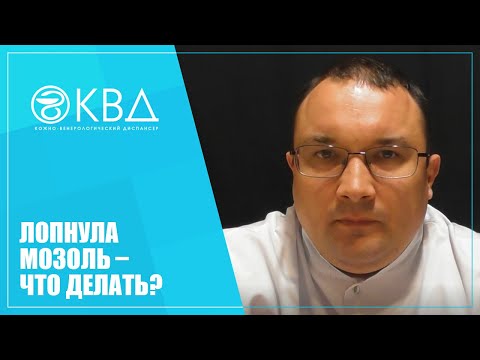 1238  Лопнула мозоль – что делать?