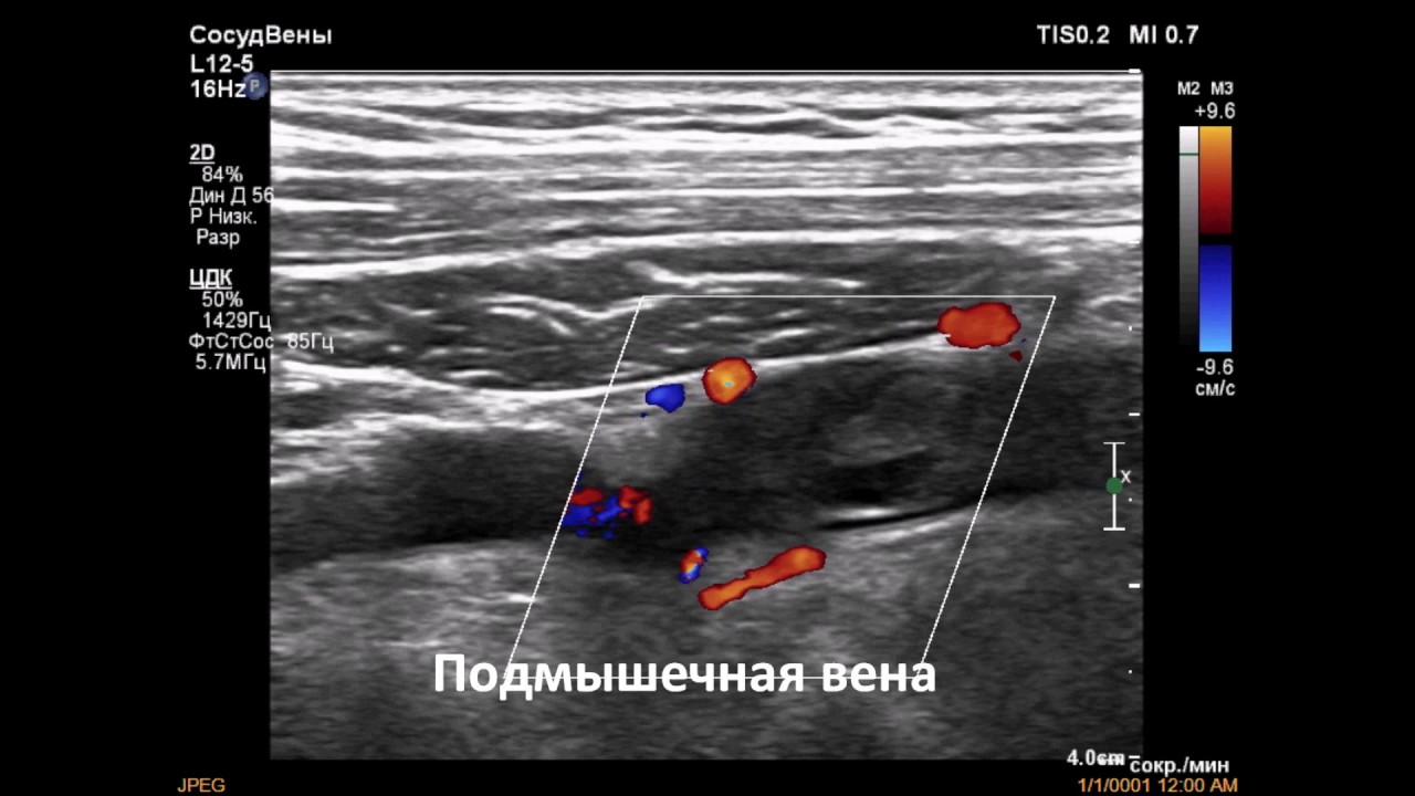 Узи вен тромбоз. Катетеризация подключичной вены тромбоз. Тромбоз подключичной артерии на УЗИ. Тромбоз подключичной вены на УЗИ.