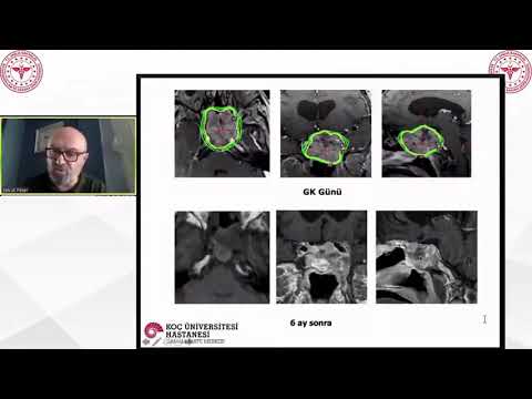 Hipofiz Adenomlarında Stereortaktik Radyocerrahi02