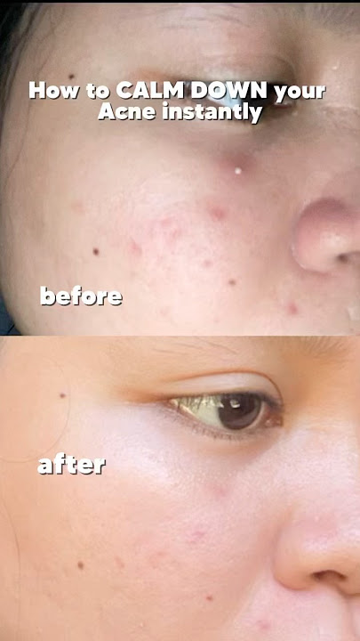 cara menghilangkan jerawat secara instan✨#shorts #shorts #acne #skincare #acnetreatment #abib #kb...
